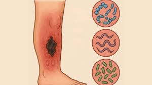 Ağrı’da et yiyen bakteri alarmı